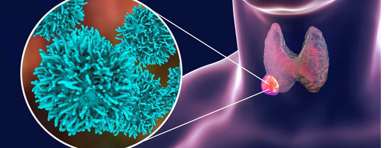 thyroid nodule
